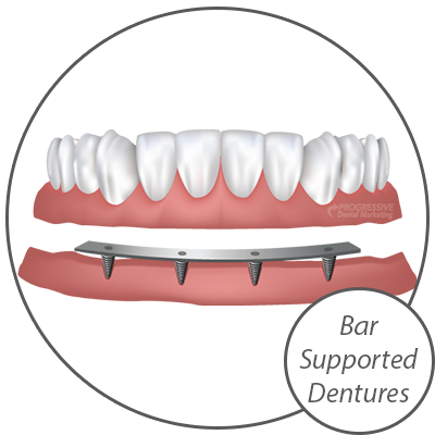 Dr. Cueva Offers A Variety of Dental Implant Options