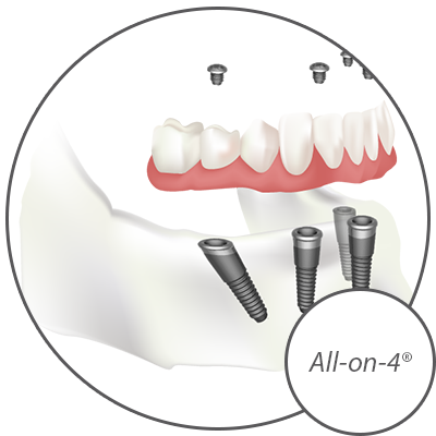 Dr. Cueva Offers A Variety of Dental Implant Options