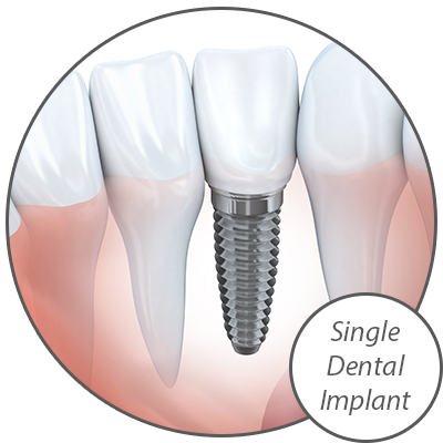 Dr. Cueva Offers A Variety of Dental Implant Options